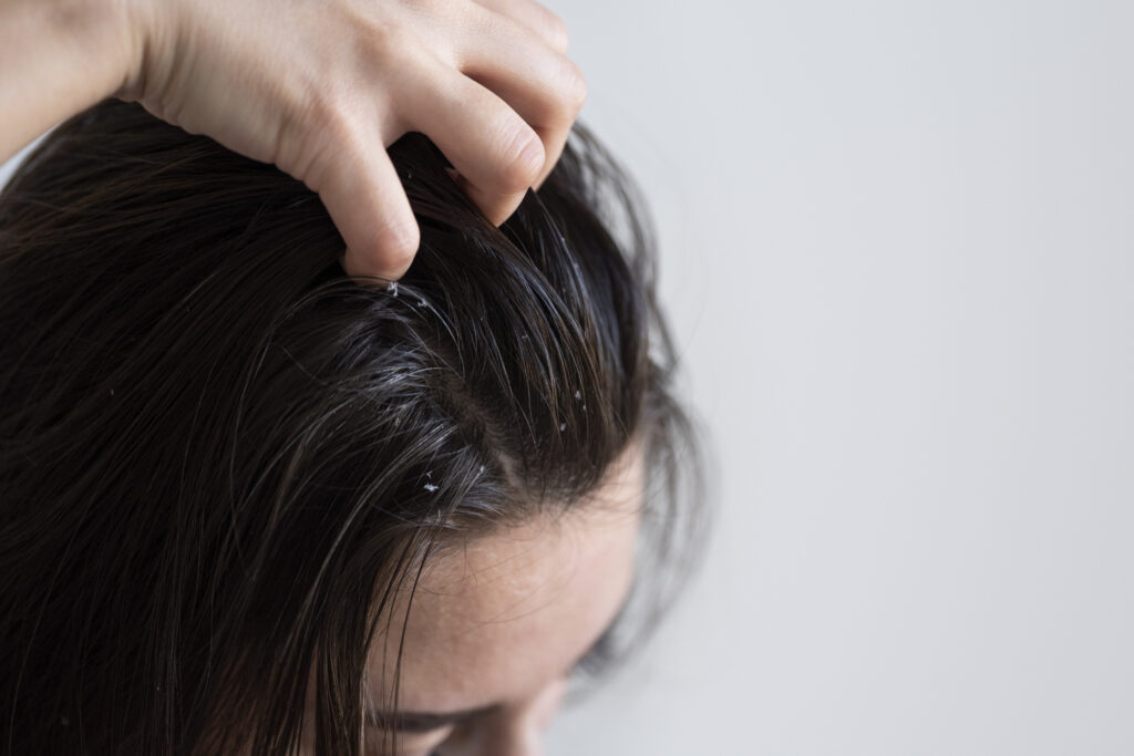 5 Best Anti dandruff Shampoo: Achieve a Flake-Free Scalp 1 5 Best Anti Dandruff Shampoo