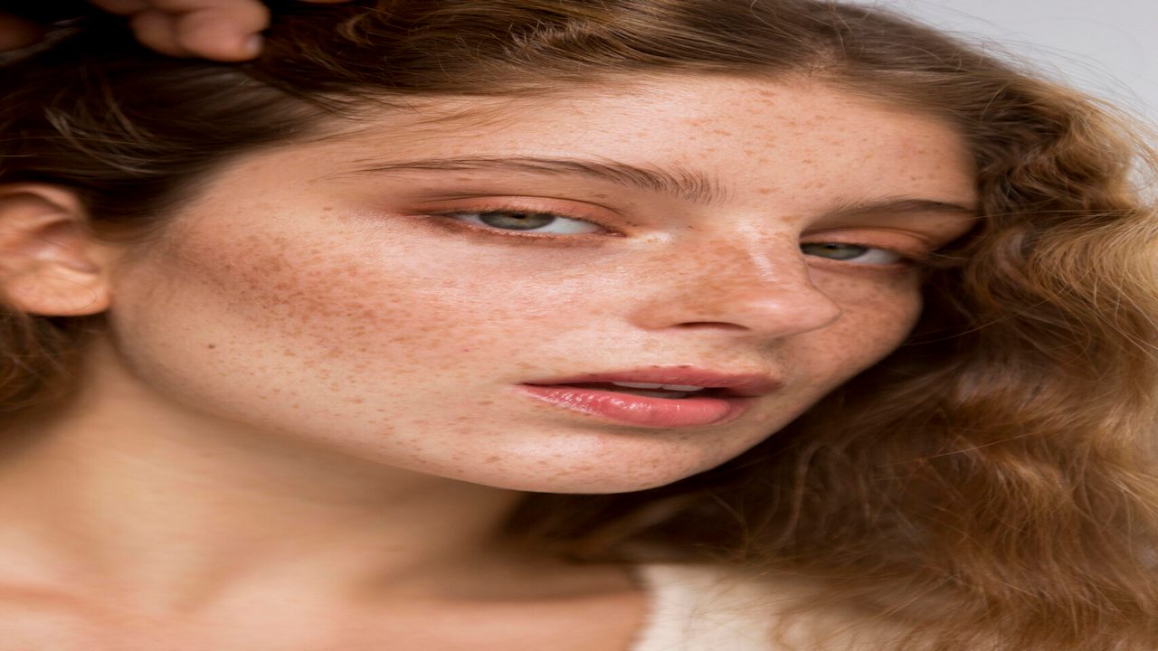 Hyperpigmentation on Face
