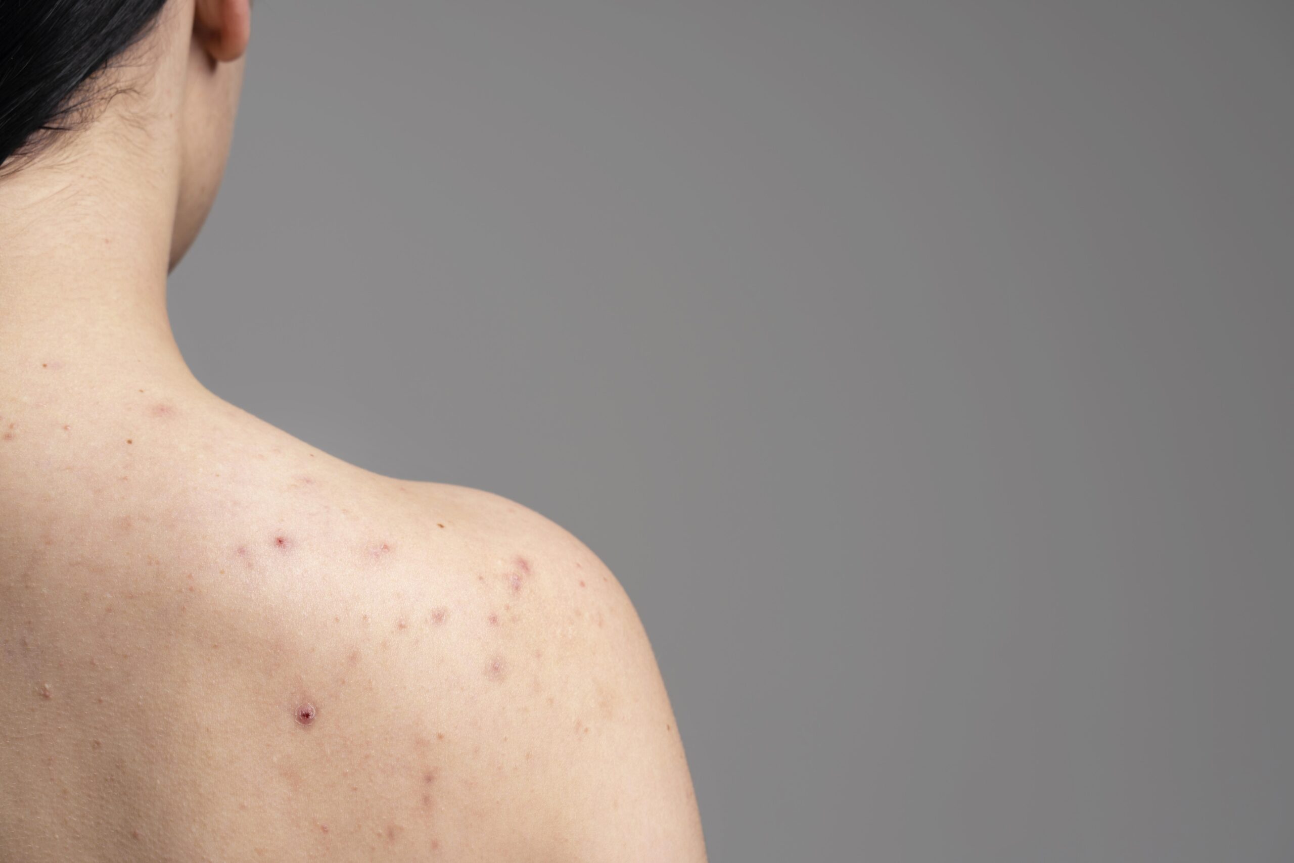 Back Acne